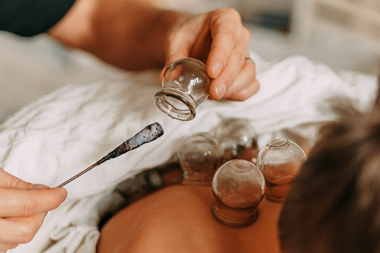 Fire Cupping. Fire cupping cups on back of young boy